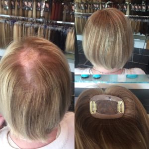 Haarstukje voor alopecia